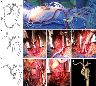 Aortic arch branch-prioritized reconstruction for type A aortic dissection surgery